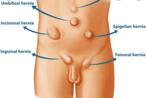 Hernia